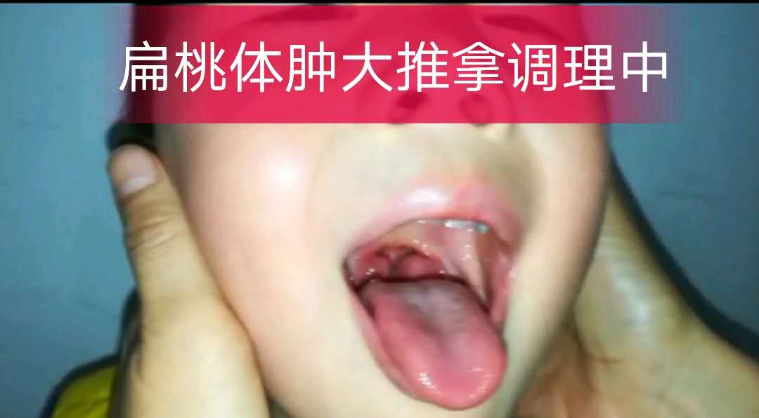 小儿推拿